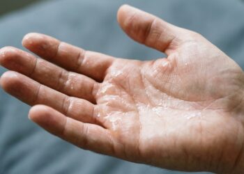 Por que algumas pessoas suam mais nas mãos do que em outras partes do corpo