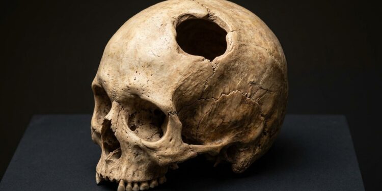 Crânio pré-colombiano peruano com abertura de trepanação e bordas ósseas cicatrizadas. - (Imagem gerada por inteligência artificial-ChatGPT/Olhar Digital)