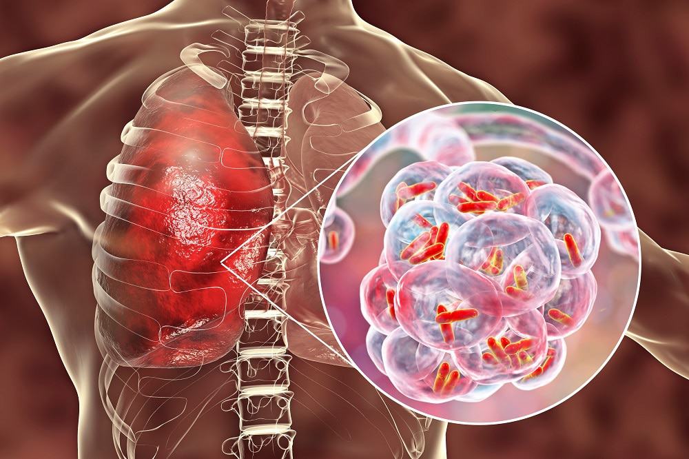 Paulo Gustavo desenvolveu pneumonia bacteriana