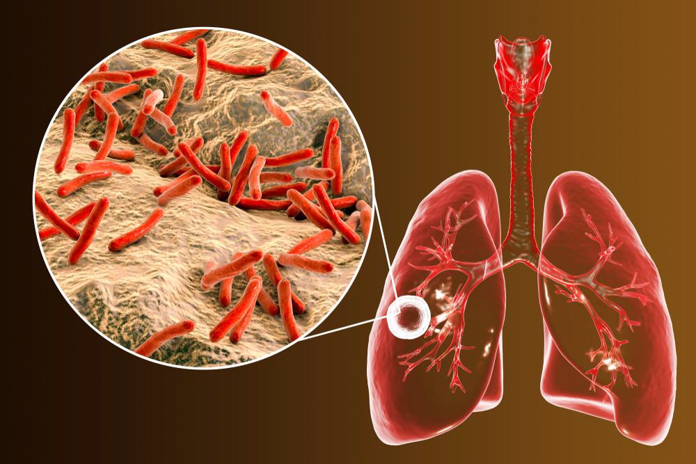 tuberculose