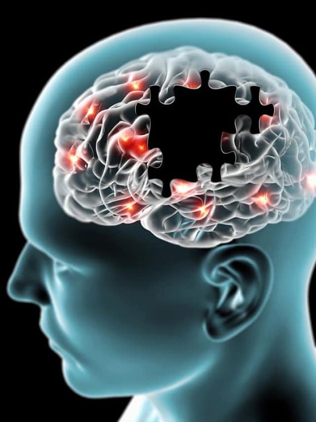 Representação gráfica de doenças degenerativas cerebrais