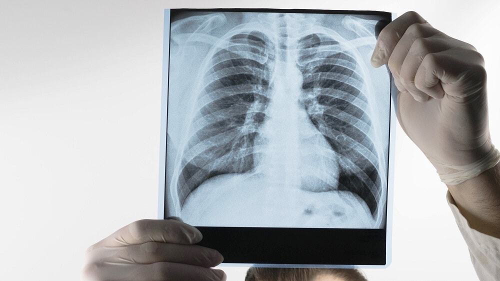 Tuberculose. Imagem: Shutterstock