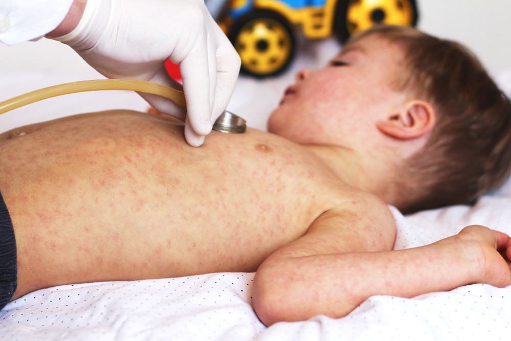 Saúde alerta para casos de sarampo e queda na vacinação no Brasil O Ministério da Saúde emitiu alerta nacional após registrar 34 casos confirmados de sarampo no país em 2025 até a Semana Epidemiológica 38 (29 de setembro a 5 de outubro). A medida visa reforçar a vigilância e as ações de prevenção nos estados e municípios, especialmente para evitar a reintrodução do vírus em território nacional. Criança infectada por sarampo sendo examinada por um médico