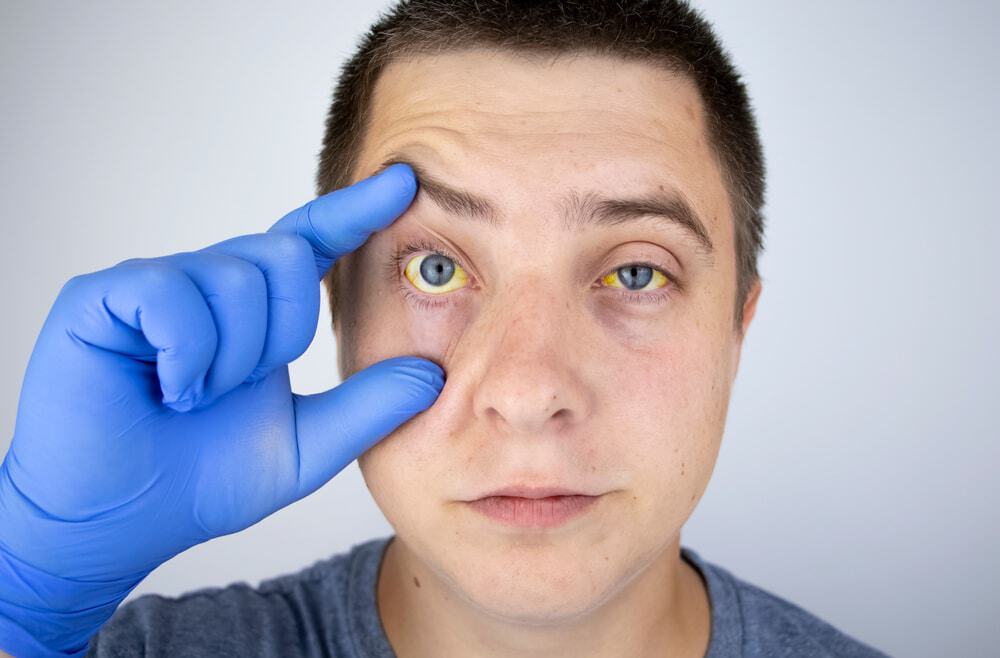Homem mostrando os olhos amarelos
