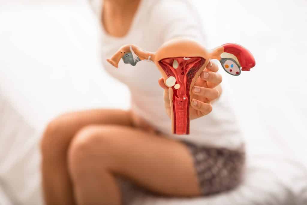mulher irreconhecível com dor abdominal detém o modelo anatômico do útero e ovários com patologia. doenças útero e ovários, endometriose, cistos ovarianos