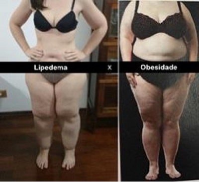 Diferenças entre um corpo com lipedema e outro com obesidade. Imagem: Divulgação/Instituto Lipedema Brasil