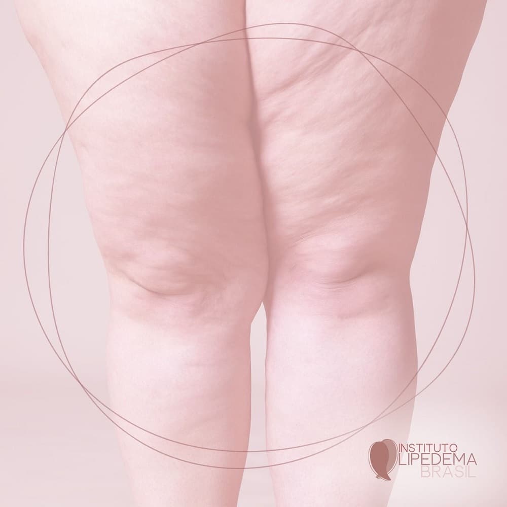 Aspecto região dos joelhos com lipedema. Imagem: Devulgação/Intituto Lipedema Brasil