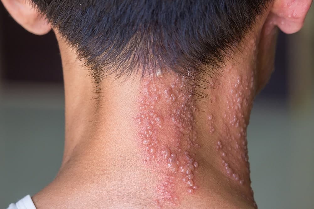 herpes zoster