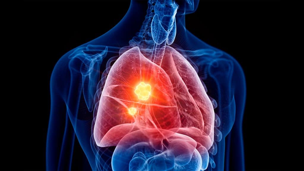 Ilustração digital de visão raio-x numa pessoa com câncer no pulmão com destaque no órgão e no tumor