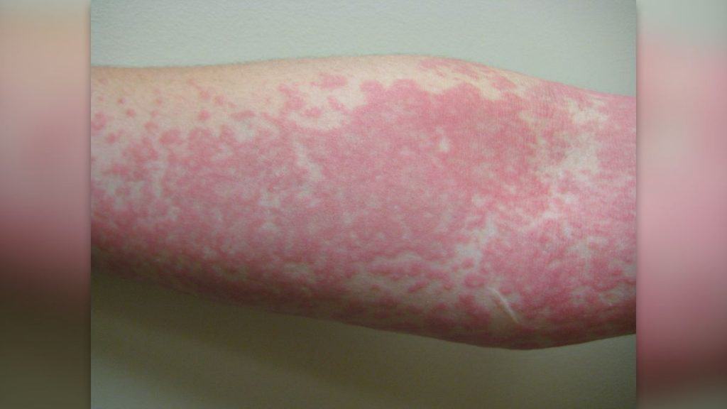 alergia a sol