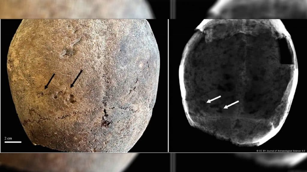 Montagem de imagens de crânio de múmias com setas apontadas para marcas que indicam uso de cocaína