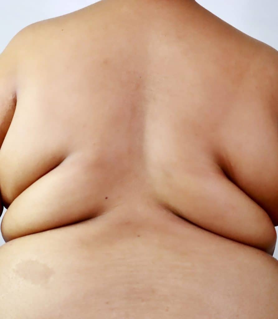Excesso de gordura pode acelerar progressão do câncer de endométrio A obesidade é há muito tempo reconhecida como um fator de risco crítico para o câncer de endométrio, com diversos estudos comprovando a correlação entre o excesso de gordura corporal e a incidência de câncer. An,African,American,Woman,With,Severe,Obesity,,Back,View,Showing