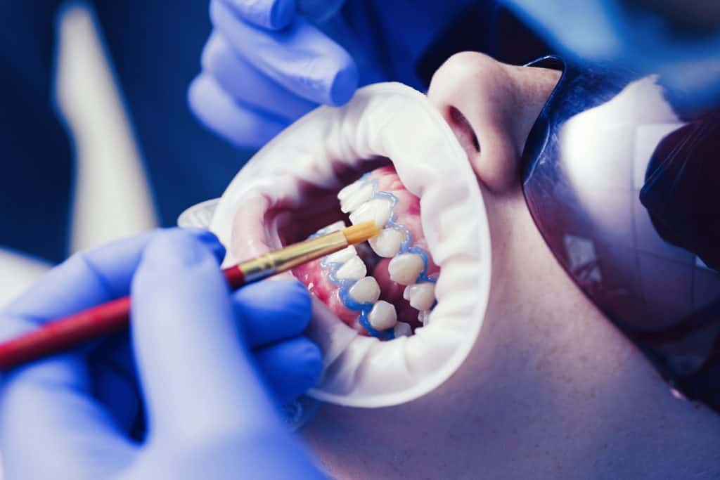 Dentes de uma pessoa sendo tratados