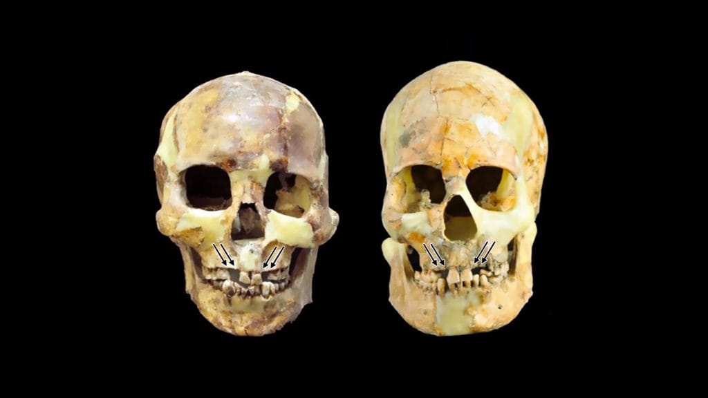 Crânios de pessoas de Taiwan que arrancaram dentes frontais