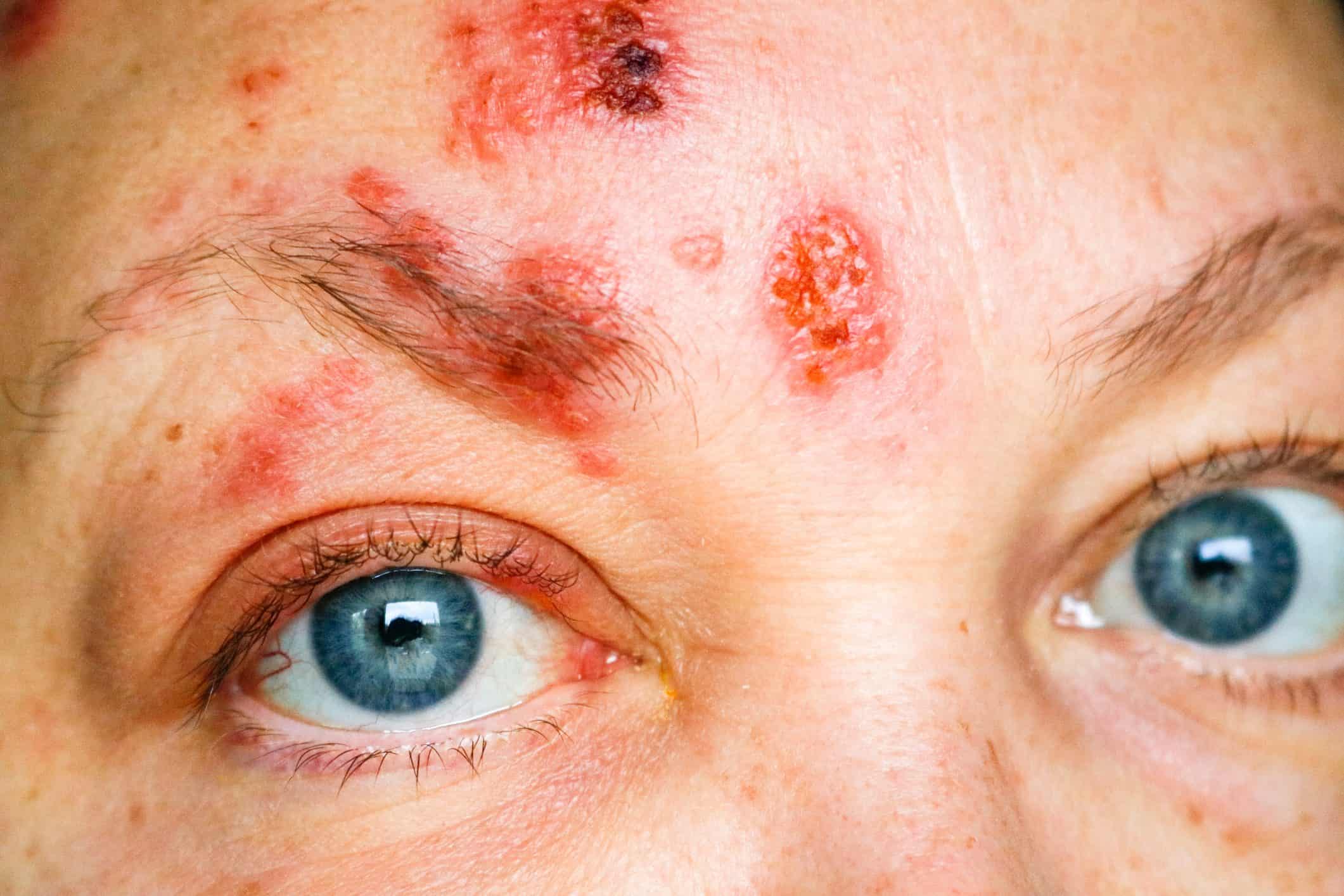 Mulher com lesões de herpes-zoster no rosto