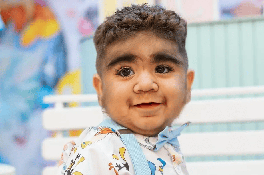 bebê com sindrome de lobisomem