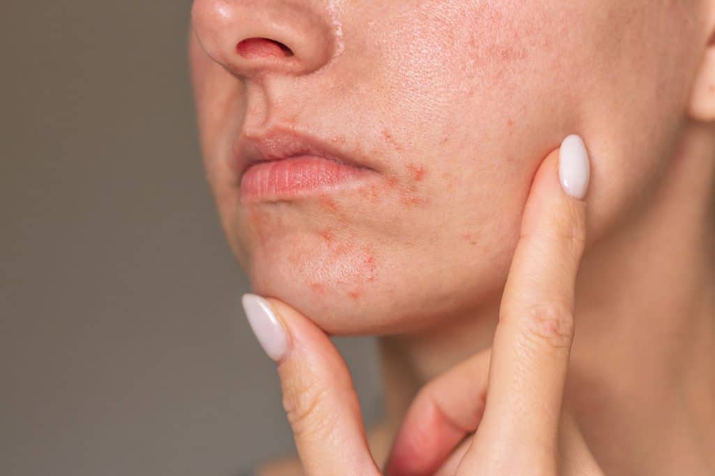 7 problemas de saúde que o uso da bucha no banho pode provocar O uso da bucha (ou esponja) de banho é um costume antigo e bastante popular entre os brasileiros. Muitas pessoas acreditam que ela é essencial para a limpeza da pele, mas dermatologistas alertam que o hábito pode ser mais prejudicial do que benéfico. Foto em close do rosto de uma mulher com dermatite perioral perto da boca.