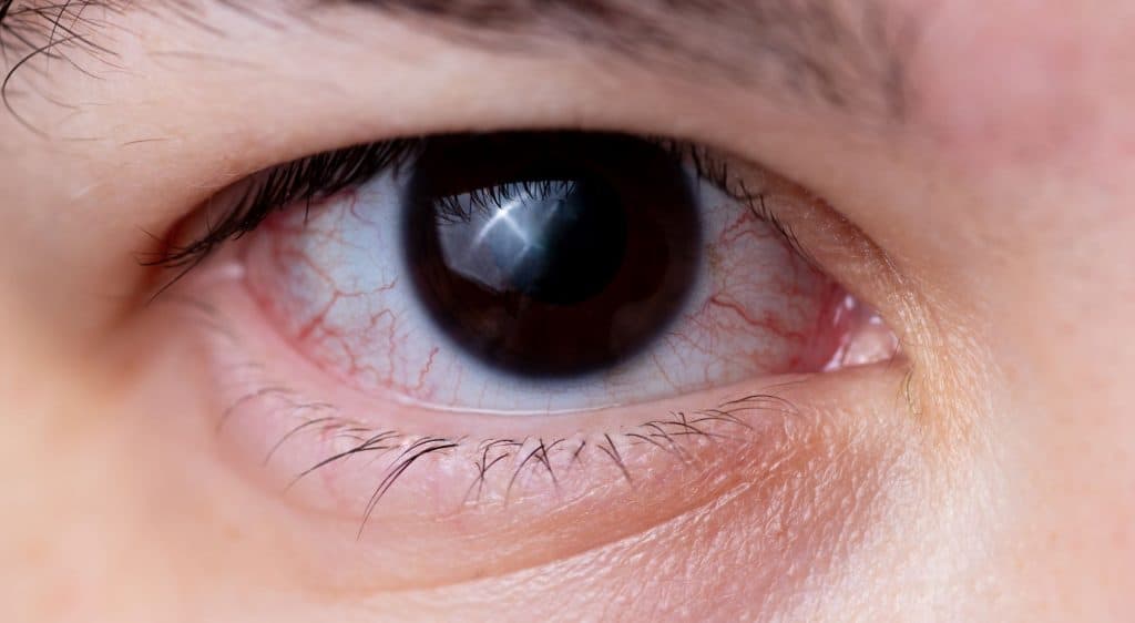 Chip nos olhos devolve visão após perda parcial Pesquisadores conseguiram, pela primeira vez, restaurar parcialmente a visão de pessoas com uma forma grave de degeneração macular relacionada à idade (DMAE) utilizando um implante de retina protético. Caso aprovado para uso mais amplo, o dispositivo pode melhorar a qualidade de vida de cerca de um milhão de pessoas nos Estados Unidos que perdem a visão central devido à doença, especialmente idosos. As informações são do The New York Times. retina