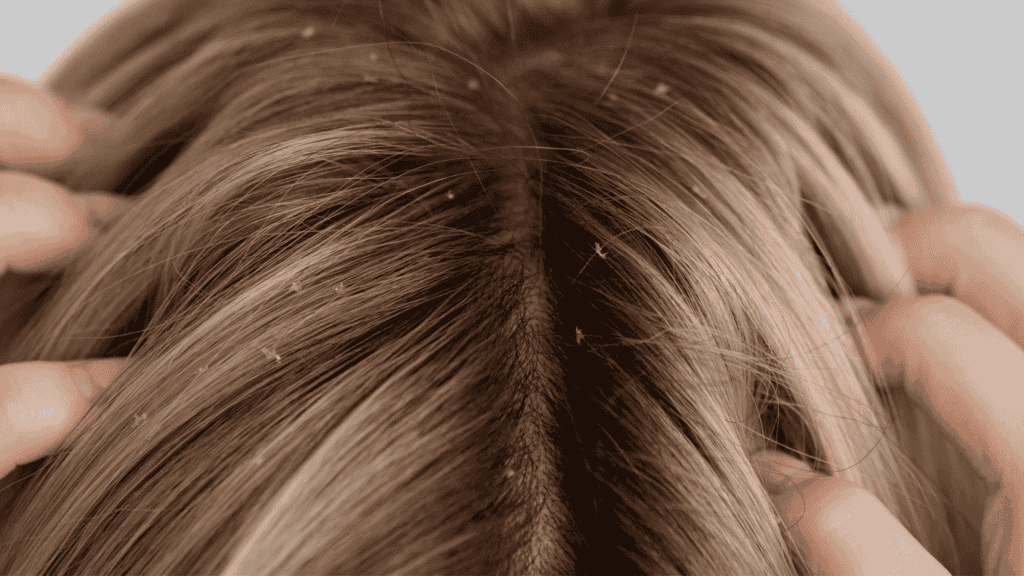 Mulher com couro cabeludo cheio de caspas