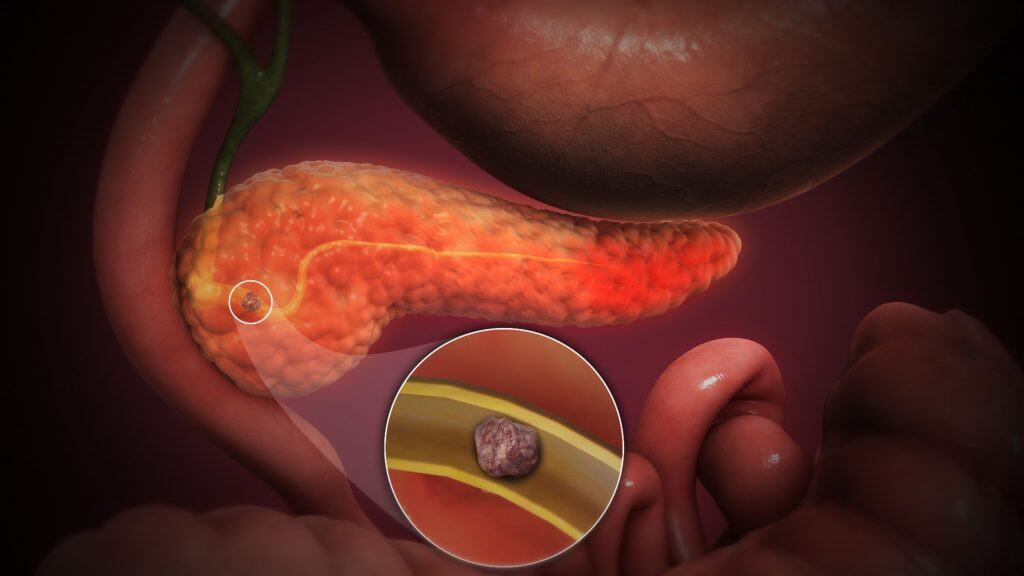 Transplantes do futuro? Pesquisadores criam minirrins em laboratório Os rins são órgãos essenciais para nossa sobrevivência. Eles limpam o sangue de impurezas, mas são extremamente complexos de serem reproduzidos à partir de células-tronco. Cálculo renal em imagem médica ilustrativa.