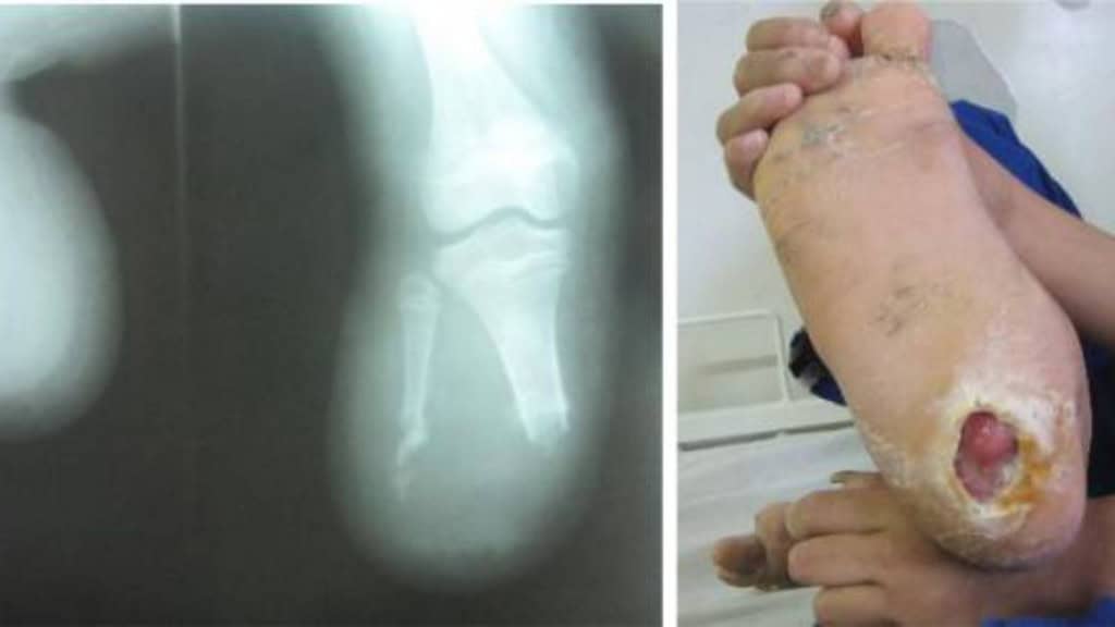 Conheça a CIPA, doença que impede o corpo de sentir dor Imagine que você encosta a mão em uma panela quente e não sente absolutamente nada. Nenhum incômodo, nenhuma dor, nenhum alerta. Agora pense que, mesmo correndo sob sol forte, seu corpo não sua, e você não percebe que está superaquecendo. a direita imagem de radiografia de pés de menino de 12 anos, e a esquerda o menino mostra um dos pés com ferimento profundo aberto.