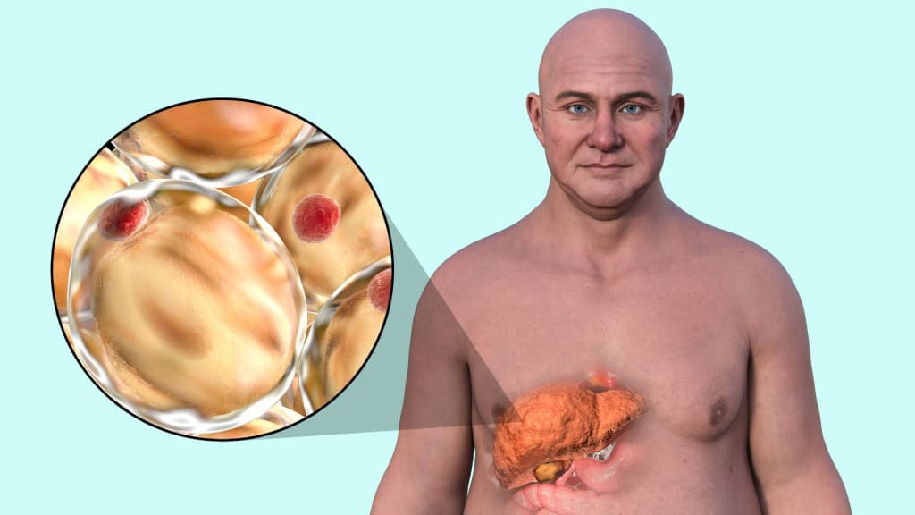 Gordura no fígado é grave? Veja sintomas e como tratar a esteatose hepática A presença de gordura no fígado, conhecida como esteatose hepática, tem se tornado uma condição cada vez mais frequente entre os brasileiros, e não apenas entre adultos. Crianças também estão sendo diagnosticadas com o problema, que afeta especialmente o público feminino. Ilustração em 3D de um homem caucasiano com pele transparente, revelando um fígado gorduroso, destacando a anatomia do fígado e o acúmulo de gordura, juntamente com uma visão de perto das células de gordura.