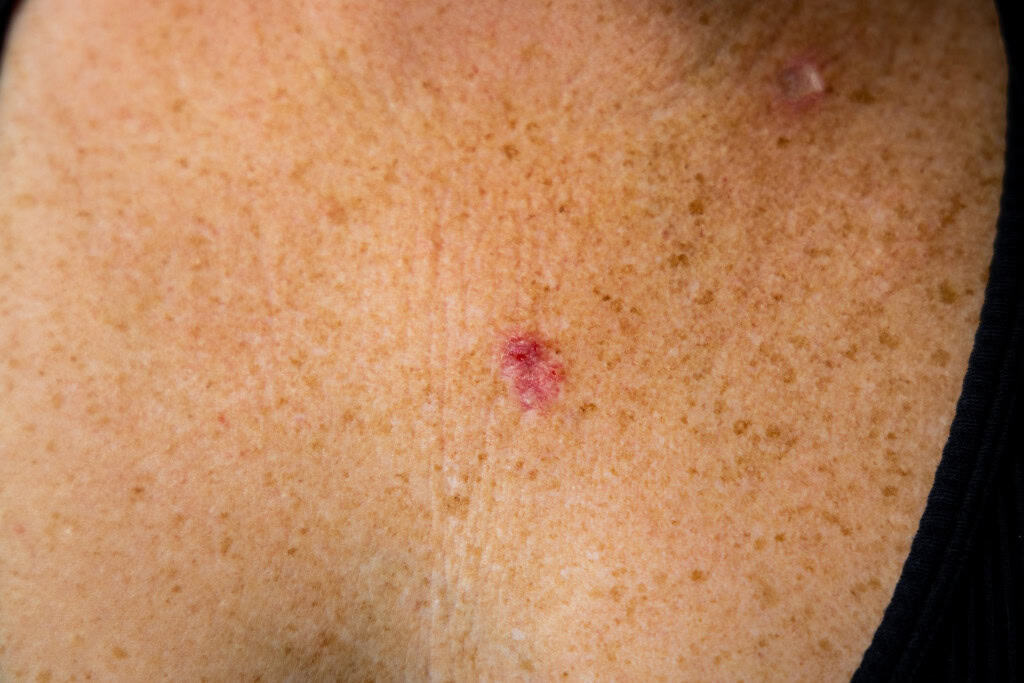 Exemplo de carcinoma