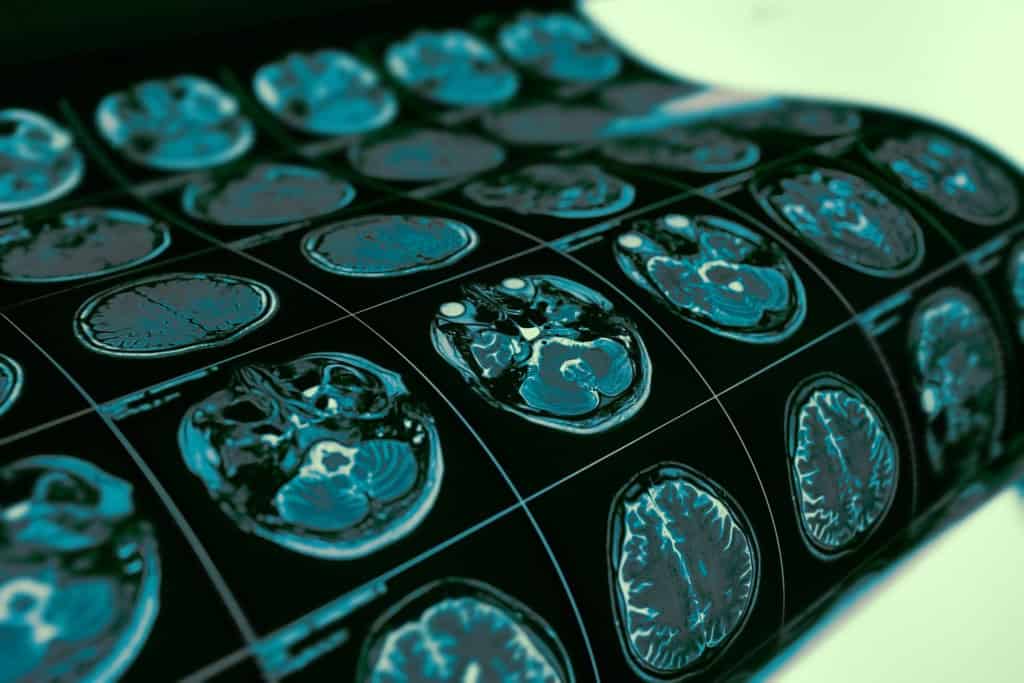 Cientistas fazem descoberta crucial sobre o autismo Uma pesquisa recente da Universidade de Cambridge indica que o autismo não deve ser visto como uma condição homogênea, mas como um conjunto de diferentes perfis biológicos e de desenvolvimento, dependendo do momento em que o diagnóstico é feito. cérebro