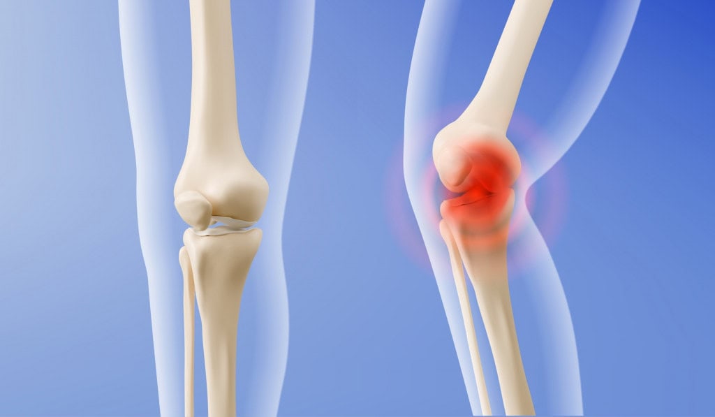 Cartilagem artificial pode aliviar sintomas da artrite A artrite é a inflamação de uma ou mais articulações do corpo. Esta condição provoca dor, inchaço, calor e rigidez, e pode ser causada por diversas doenças, como as autoimunes (artrite reumatoide), infecciosas (artrite séptica) ou degenerativas (artrose). Cartilagem artificial pode aliviar sintomas da artrite