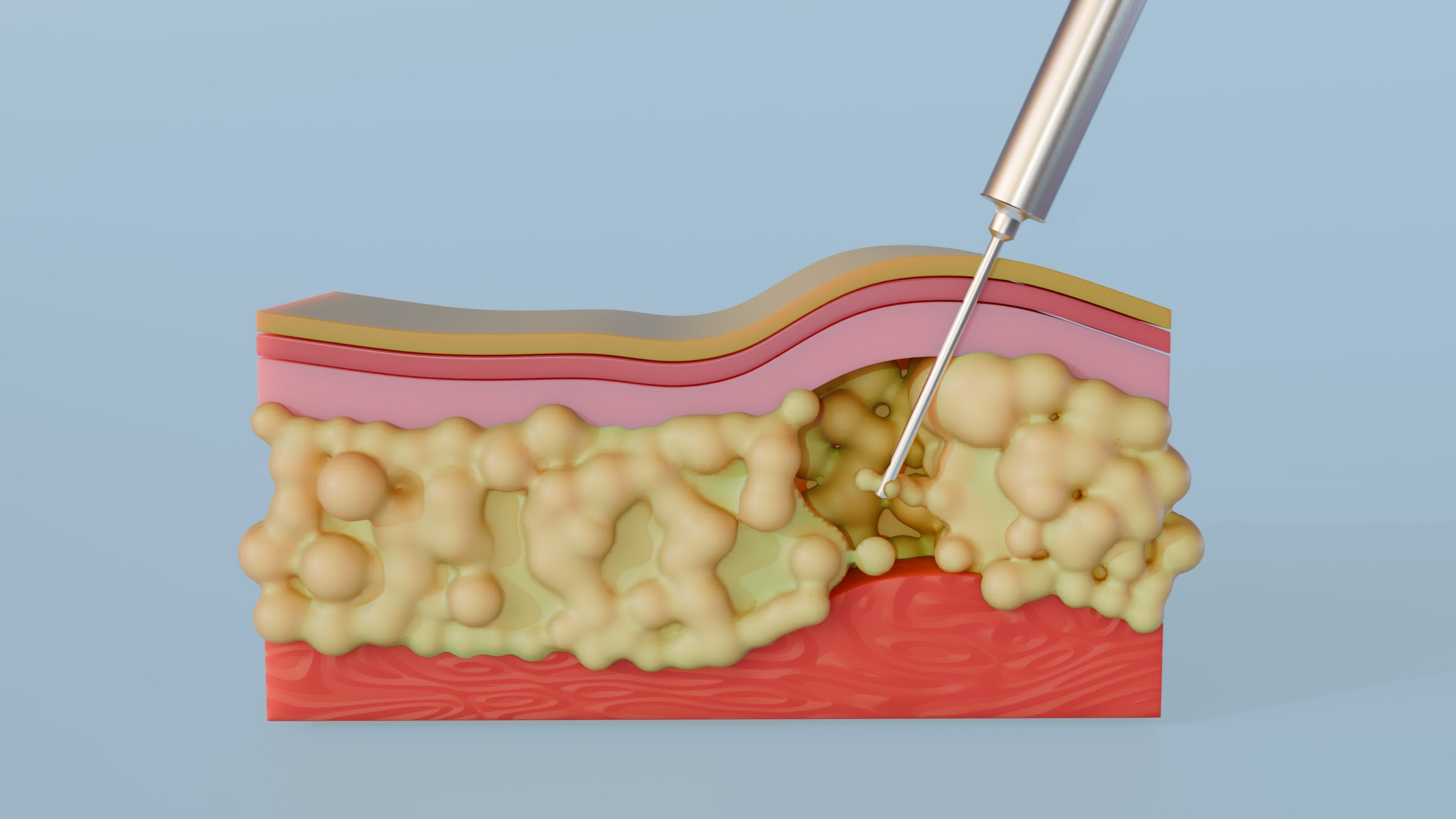 Lipoaspiração: o que é, quais os riscos e benefícios para a saúde? A lipoaspiração é um dos procedimentos estéticos mais realizados no Brasil e no mundo. Popular por remodelar o corpo e eliminar depósitos localizados de gordura, ela continua despertando grande interesse, e também muitas dúvidas. Uma renderização 3D ilustrando o processo de lipoaspiração, mostrando especificamente uma cânula removendo ativamente a gordura da camada subcutânea
