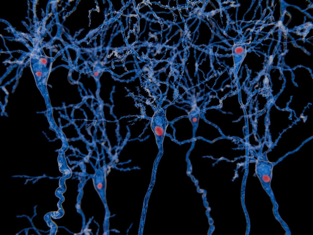 neurônios com corpo de lewy