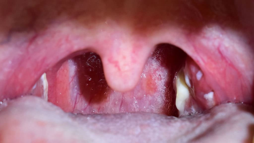 garganta em closeup com pontos brancos