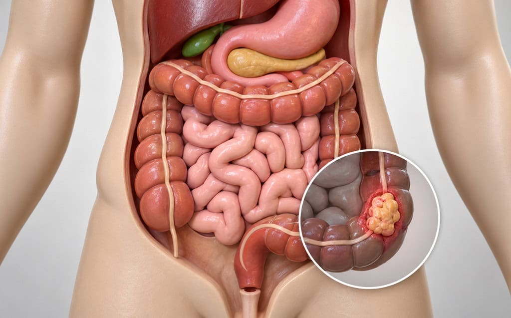 O SUS também amplia o rastreamento do câncer de intestino, com distribuição de 400 mil testes para diagnóstico precoce.